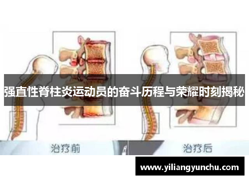 强直性脊柱炎运动员的奋斗历程与荣耀时刻揭秘
